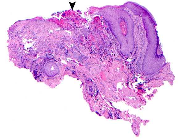 Histopathology of Herpes simplex infection of skin Courtesy of Dr. Cary Chisholm, Department of Pathology, Scott & White Memorial Hospital, Temple, Texas