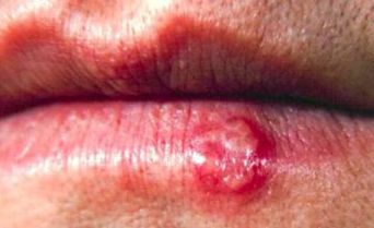 cold sores on lips