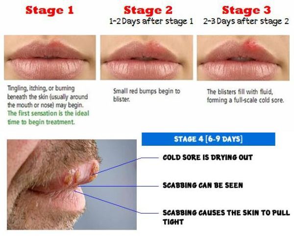 cold sore 4 stages