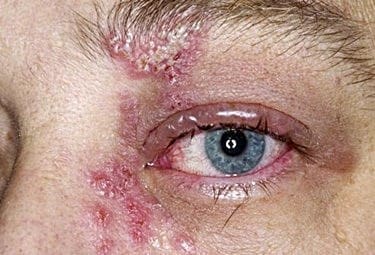 Ocular Herpes. Permanent cure for cold sores?