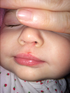 Cold Sores in Toddlers