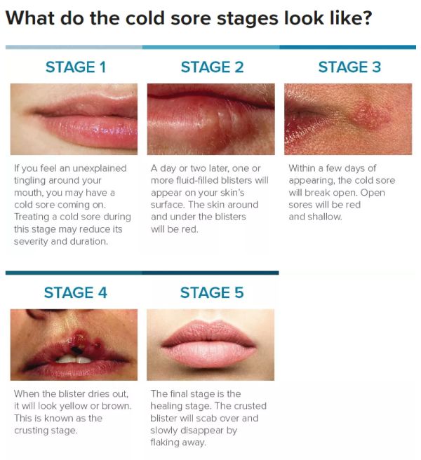 cold sore stages