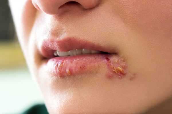 stages of cold sores