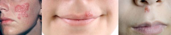 stages of cold sores blister