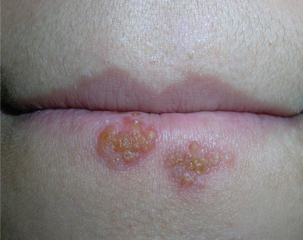 scabbing crusting stage of cold sore