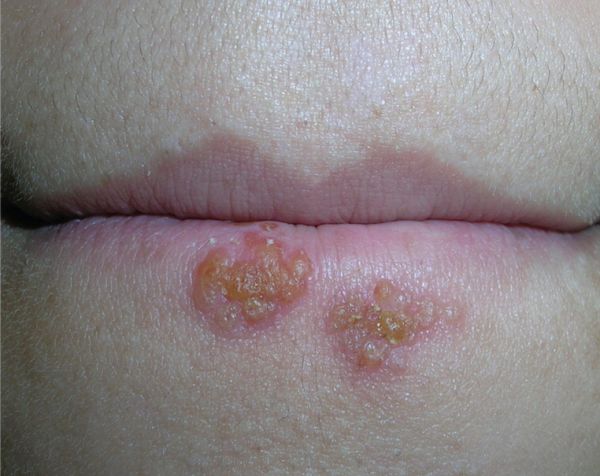 Cold Sore Stages With Pictures The 5 Stages Of Cold Sore Outbreak