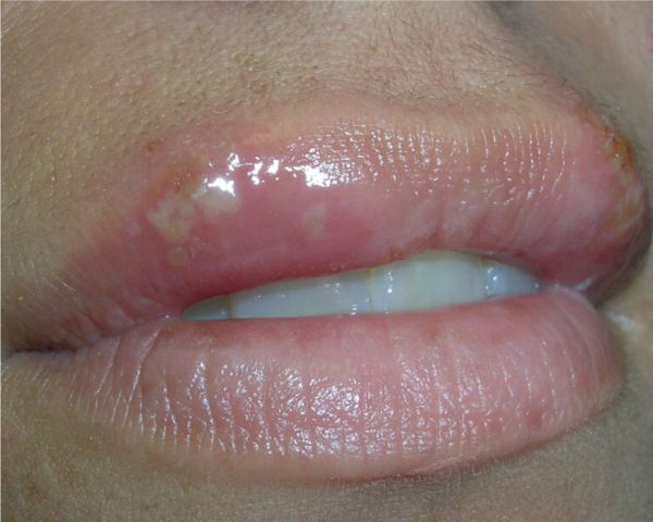 Can Cold Sore Make You Feel Sick