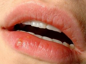 blister on lip