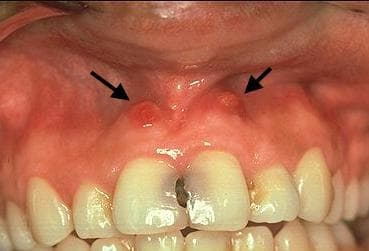canker sores on gums