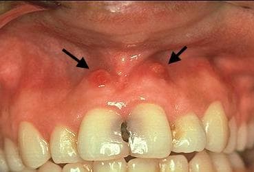 Canker Sores in Mouth - How to Get Rid, Treatment Options & Medicine