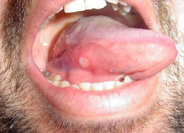 Canker Sore Under Tongue