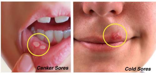 Cold Sores and Canker Sores