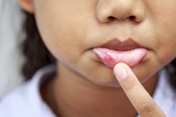 canker sores in kids