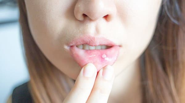 canker-sores-in-mouth-how-to-get-rid-treatment-options-medicine