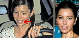 List of Celebrities with Cold Sores - How do Celebrities Treat Herpes